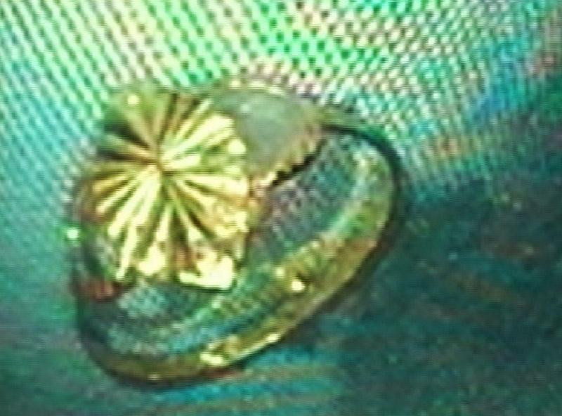 Bằng phương pháp nội soi bác sĩ đã lấy thành công chiếc nhẫn vàng ra khỏi cơ thể bệnh nhi Bằng phương pháp nội soi bác sĩ đã lấy thành công chiếc nhẫn vàng ra khỏi cơ thể bệnh nhi