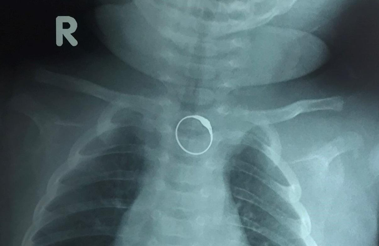 Hình ảnh X-quang phát hiện dị vật là chiếc nhẫn đang bị kẹt ở thực quản của bệnh nhi Hình ảnh X-quang phát hiện dị vật là chiếc nhẫn đang bị kẹt ở thực quản của bệnh nhi