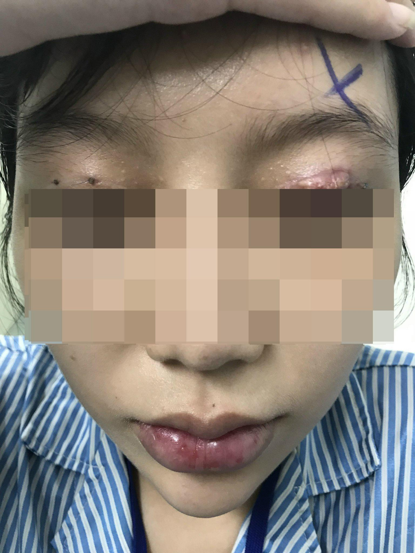 Bệnh nhân bị tai biến khi đi cắt mí làm đẹp tại cơ sở thẩm mỹ tư nhân Bệnh nhân bị tai biến khi đi cắt mí làm đẹp tại cơ sở thẩm mỹ tư nhân