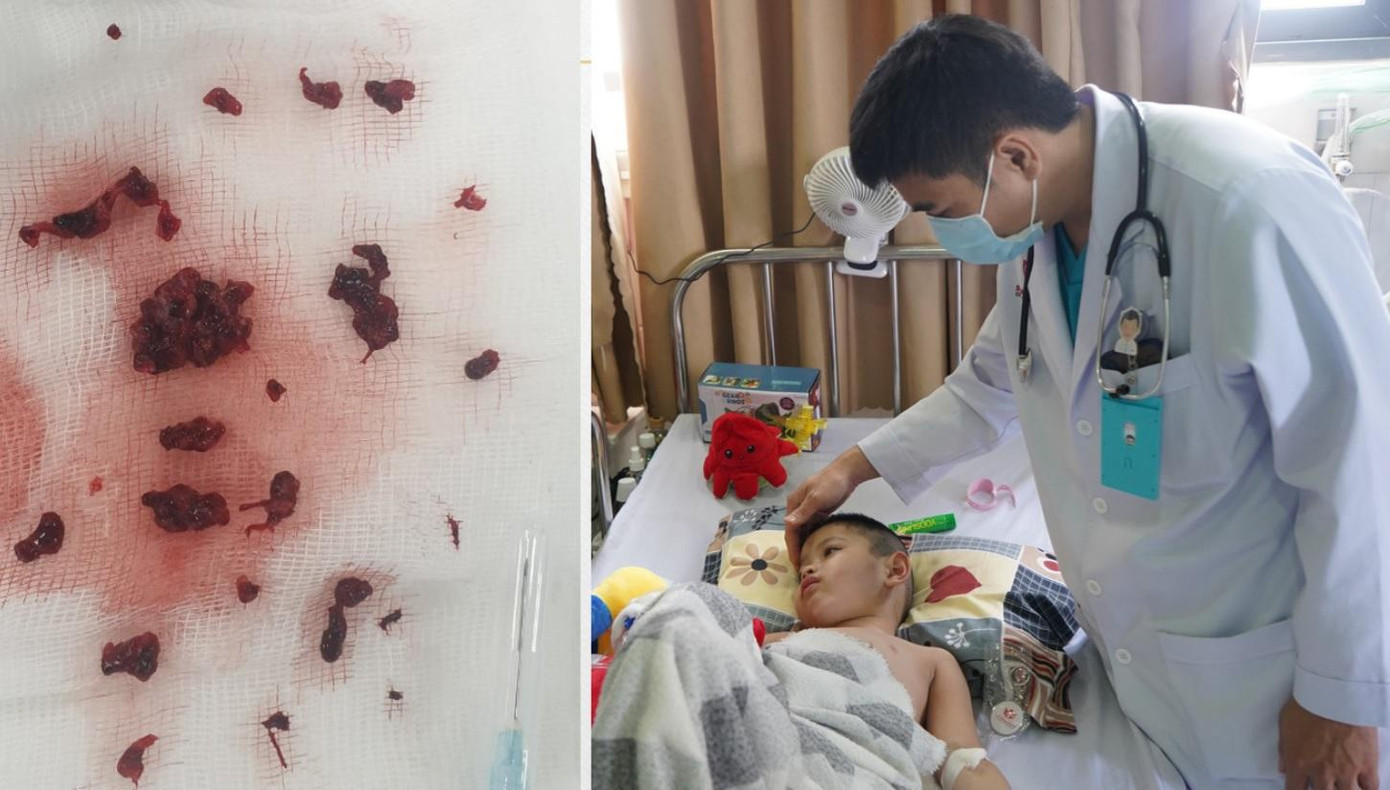 Các bác sĩ đã can thiệp lấy máu đông khai thông mạch máu giúp bệnh nhi qua cơn nguy kịch Các bác sĩ đã can thiệp lấy máu đông khai thông mạch máu giúp bệnh nhi qua cơn nguy kịch