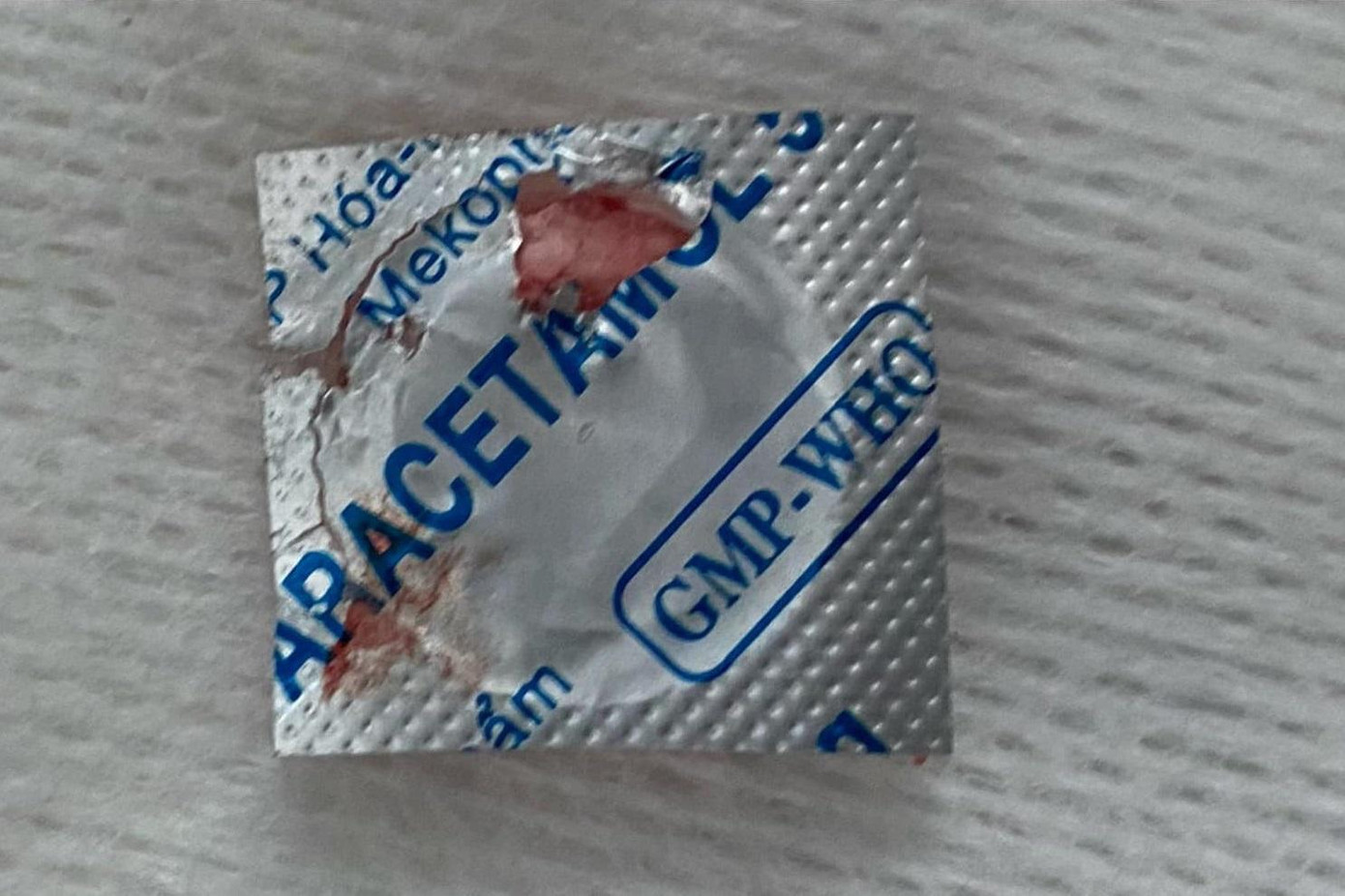 Dị vật được các bác sĩ thực hiện nội soi cấp cứu gắp thành công ra ngoài Dị vật được các bác sĩ thực hiện nội soi cấp cứu gắp thành công ra ngoài