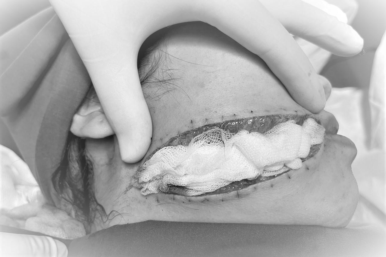 Vết thương dài 12cm kéo dài từ môi đến sát vùng cổ gáy của bệnh nhân Vết thương dài 12cm kéo dài từ môi đến sát vùng cổ gáy của bệnh nhân