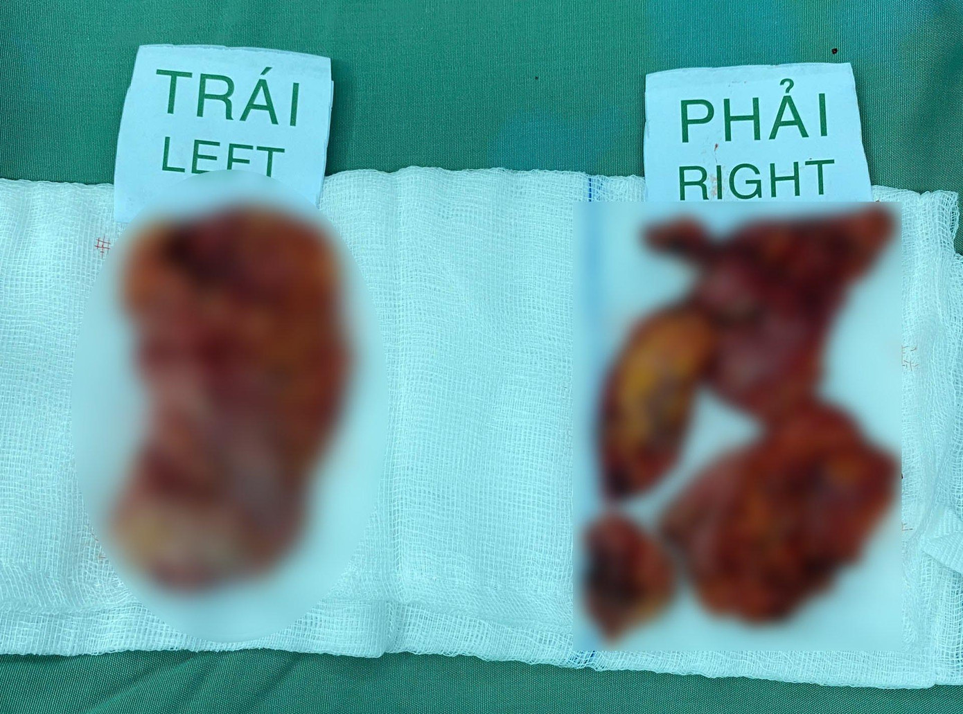 Lớp mỡ tự thân bị nhiễm trùng, hoại tử sau khi thực hiện phương pháp cấy không an toàn vào vùng ngực người bệnh Lớp mỡ tự thân bị nhiễm trùng, hoại tử sau khi thực hiện phương pháp cấy không an toàn vào vùng ngực người bệnh