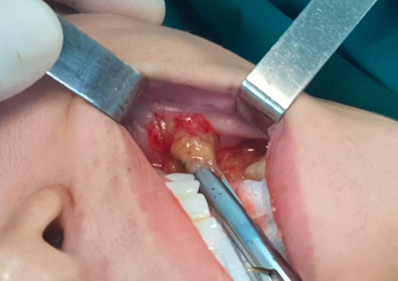 Tình trạng nhiễm trùng hoại tử xâm lấn cả vào khoang miệng của người bệnh Tình trạng nhiễm trùng hoại tử xâm lấn cả vào khoang miệng của người bệnh