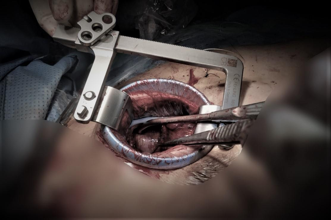 Thay vì phải xẻ xương ức, phương pháp phẫu thuật mới chỉ cần mở ngực phải để tiếp cận trái tim Thay vì phải xẻ xương ức, phương pháp phẫu thuật mới chỉ cần mở ngực phải để tiếp cận trái tim