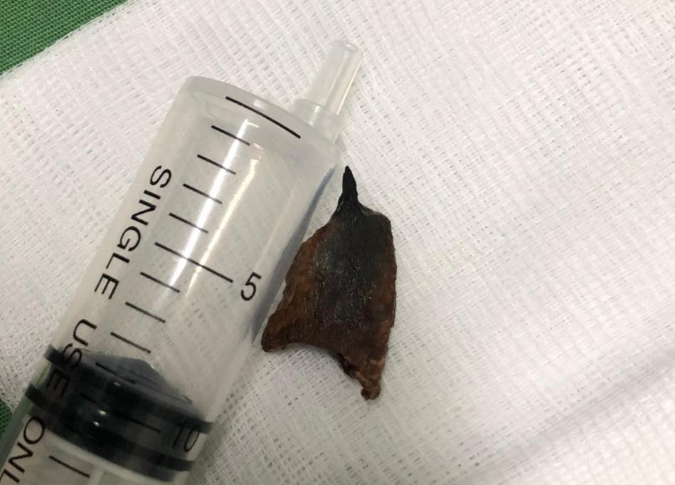 Sau nhiều nỗ lực, các bác sĩ đã kéo thành công dị vật ra khỏi cơ thể bệnh nhân