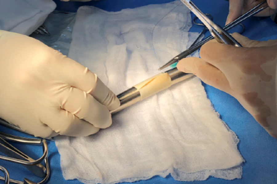 Màng ngoài tim bò đã qua xử lý được bác sĩ sử dụng để tạo động mạch chủ bụng cho bệnh nhân Màng ngoài tim bò đã qua xử lý được bác sĩ sử dụng để tạo động mạch chủ bụng cho bệnh nhân