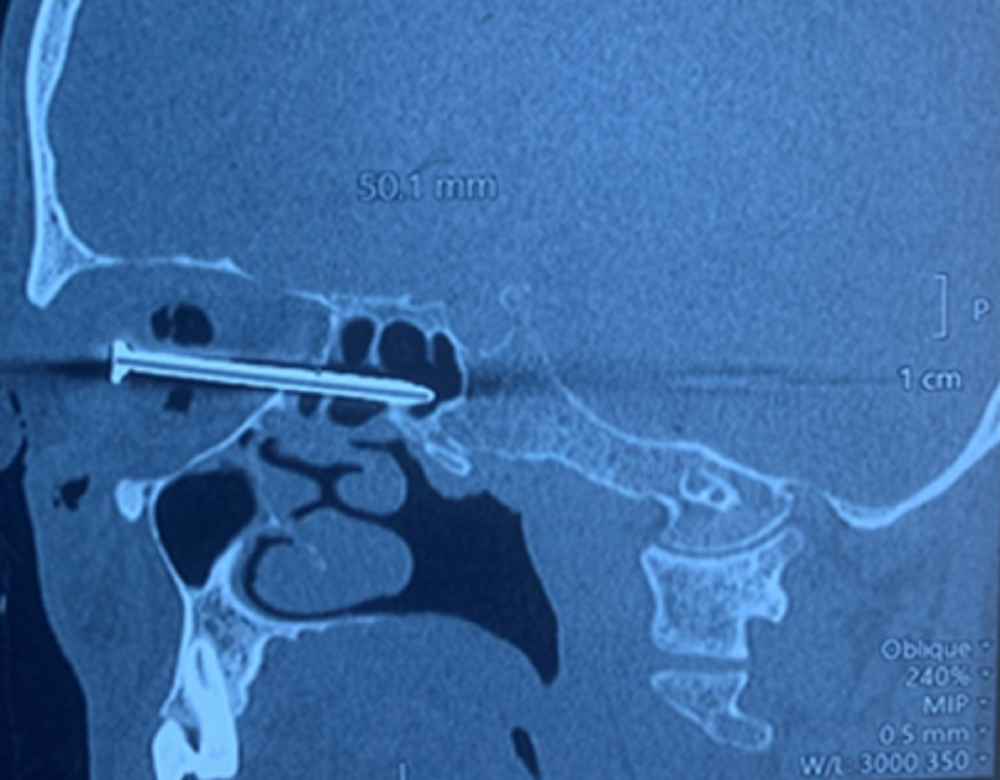 Chiếc đinh xuyên vào hốc mắt khiến nạn nhân mất hoàn toàn thị lực mắt phải