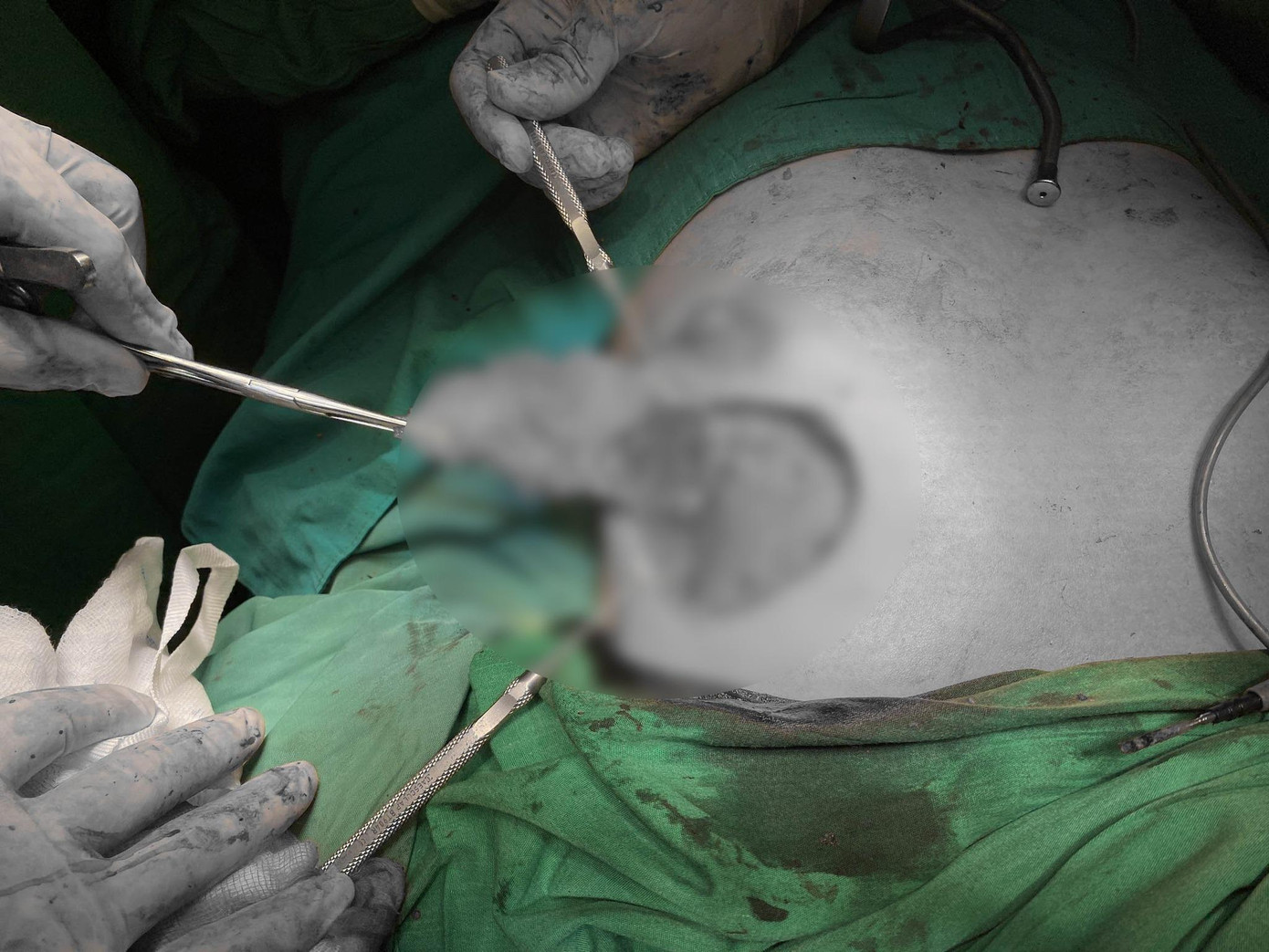 Các bác sĩ thực hiện cuộc phẫu thuật xử lý tình trạng nhiễm trùng sau nâng ngực cho bệnh nhân Các bác sĩ thực hiện cuộc phẫu thuật xử lý tình trạng nhiễm trùng sau nâng ngực cho bệnh nhân