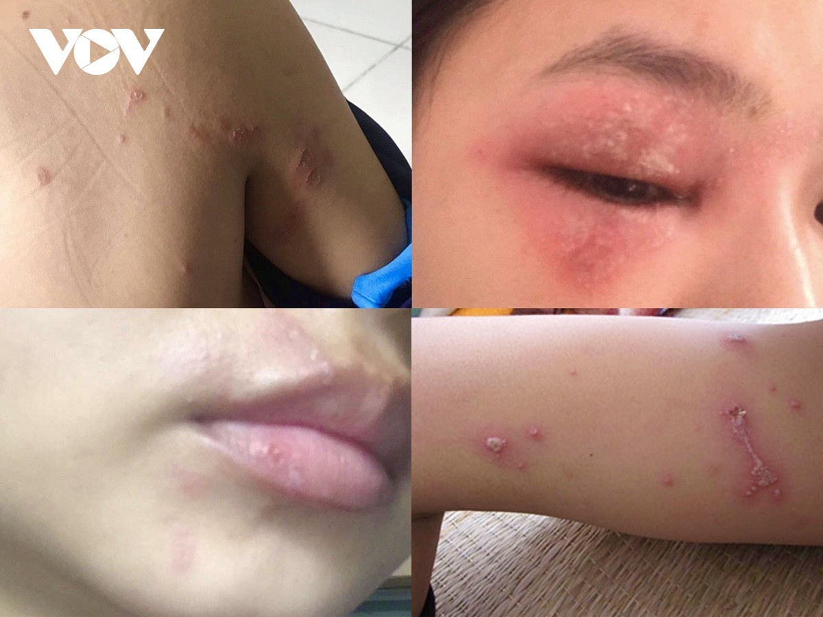 Các vết thương do kiến ba khoang gây ra (Ảnh: Kiều Oanh)