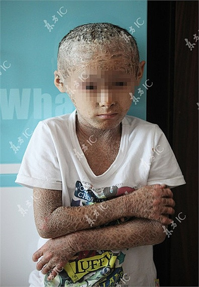 Nhiều người dân tại địa phương thường gọi bé là 'em bé cá' do cơ thể bé bị bao phủ bởi một lớp vảy