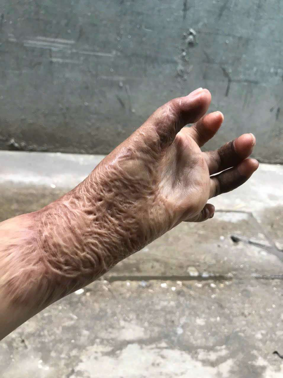 Hai tay của Dung vẫn bị sẹo co kéo. Ảnh: NVCC.