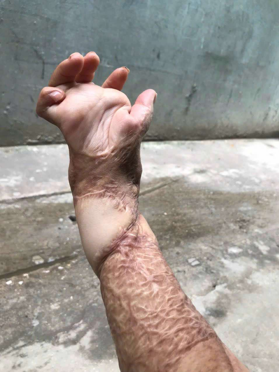 Hai tay của Dung vẫn bị sẹo co kéo. Ảnh: NVCC.