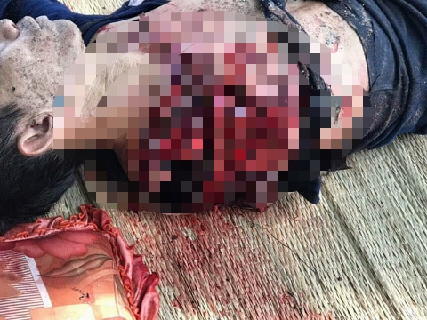 Người đàn ông bị hổ cắn đứt lìa 2 tay ở Bình Dương ảnh 1