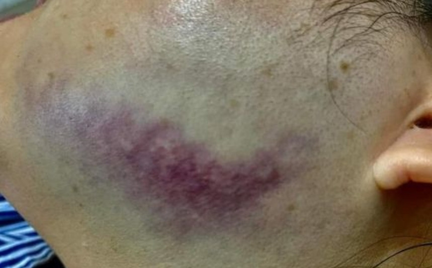 Chị T. bị hành hung khiến bầm tím bên trái mặt phải tới bệnh viện để khám.