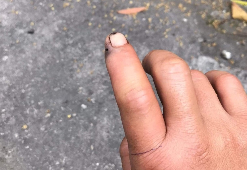 Đầu ngón tay bầm tím của anh H. sau khi bị rắn cắn. Đầu ngón tay bầm tím của anh H. sau khi bị rắn cắn.