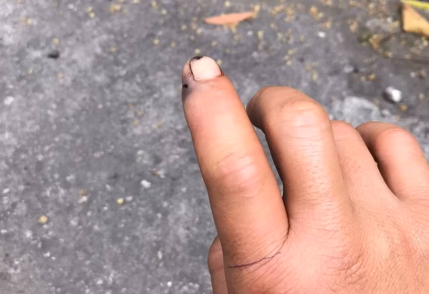 Đầu ngón tay bầm tím của anh H. sau khi bị rắn cắn.