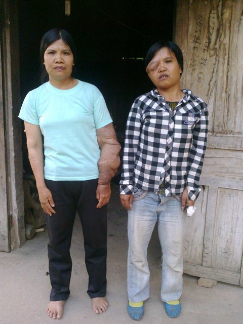 Chị Hoa và chị Vui sống với thân hình 