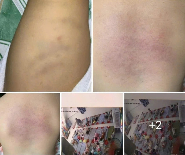 Hình ảnh người thân cháu Q. chia sẻ lên mạng xã hội, nghi cháu Q. bị bạo hành.