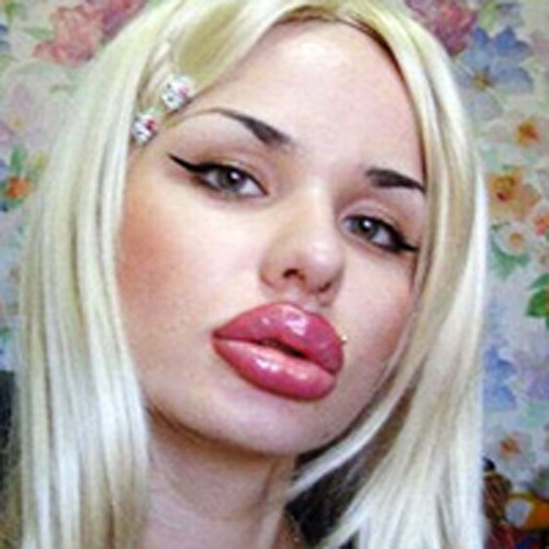 Và sau khi bơm môi