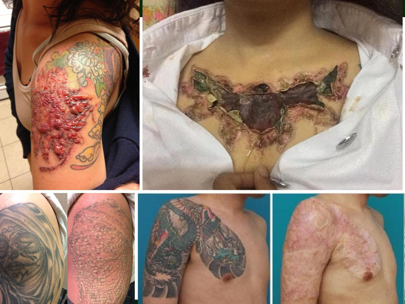 Không ít người xóa hình xăm để lại sẹo. Ảnh: Fanpage HNBXG