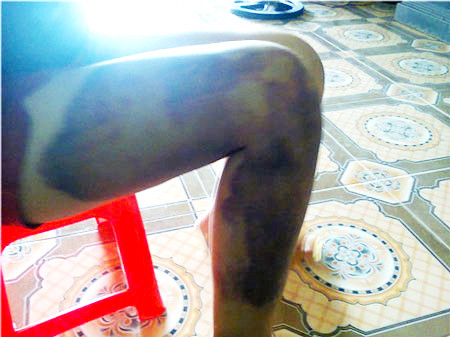 Những vết bầm tím thể hiện sự đánh đập dã man của đối tượng Hùng với chị Biên. Những vết bầm tím thể hiện sự đánh đập dã man của đối tượng Hùng với chị Biên