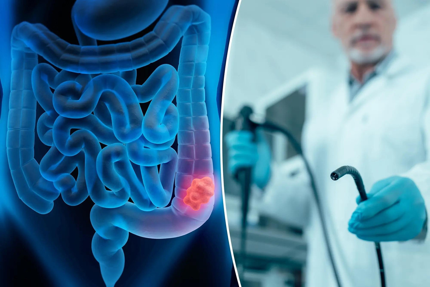 Minh họa y tế về Ung thư Đại trực tràng - Polyp Minh họa y tế về Ung thư Đại trực tràng - Polyp