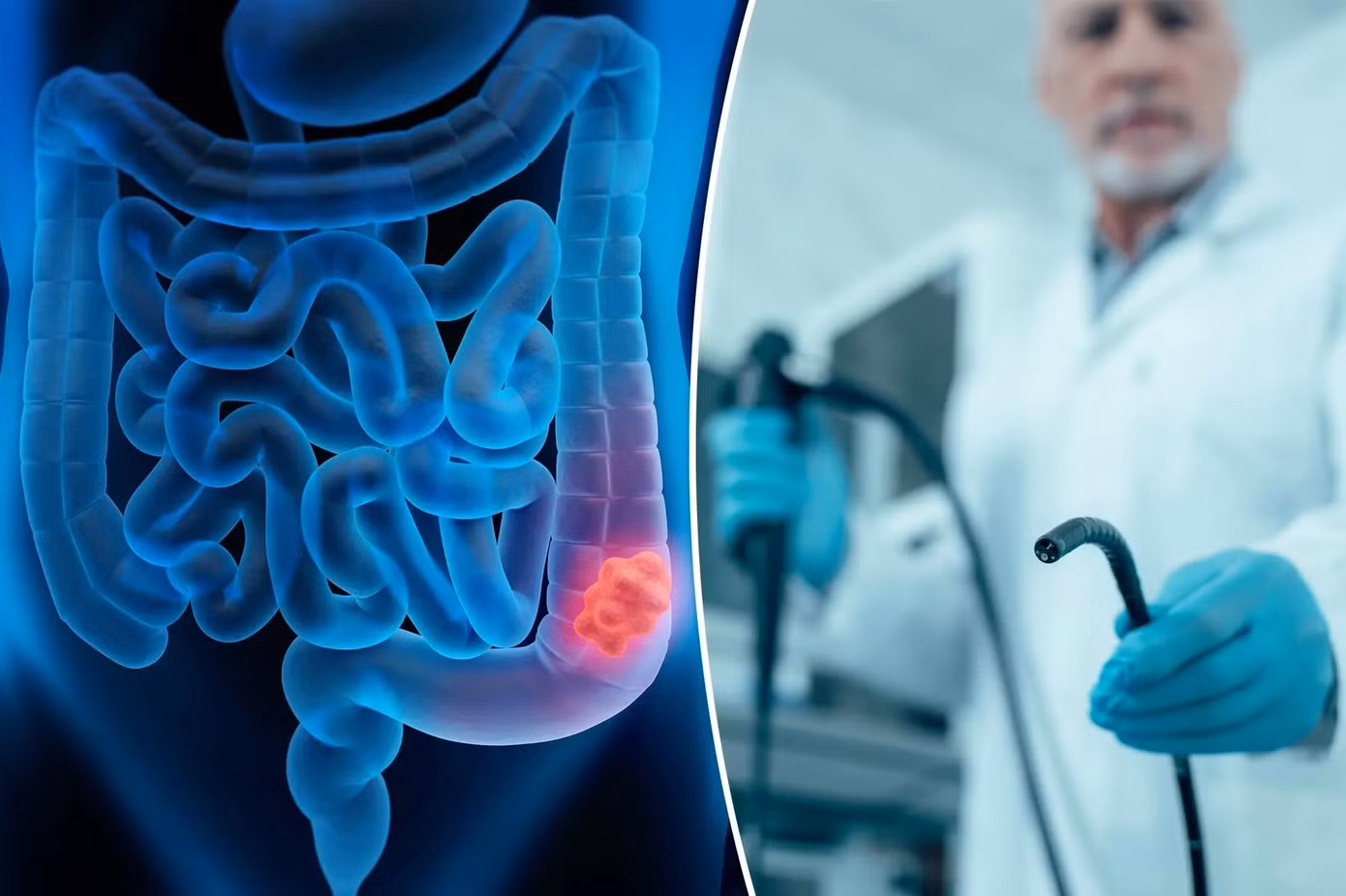 Minh họa y tế về Ung thư Đại trực tràng - Polyp