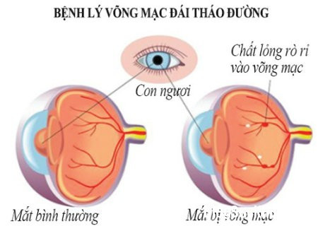 Tiểu đường hại mắt thế nào?