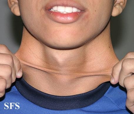 Những căn bệnh có một không hai trên thế giới