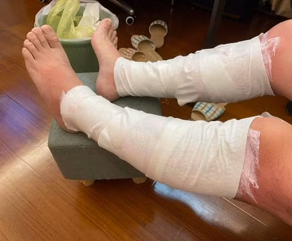 Andy phải băng bó cả hai chân. Ảnh: Andy.