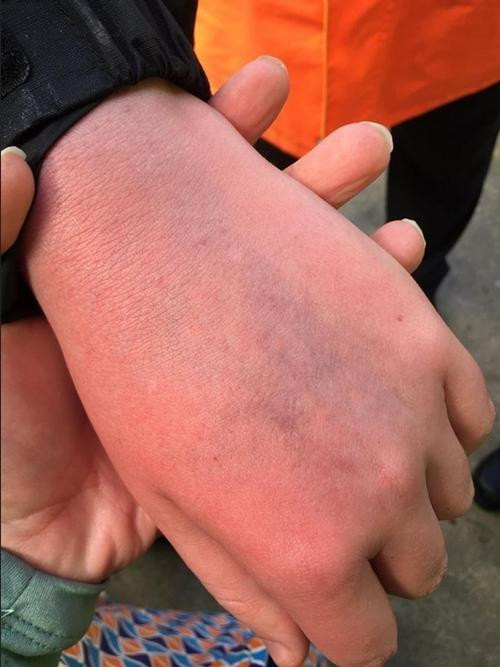 Tay Jake thì bị bầm. Ảnh: Sarah Kelly. Tay Jake thì bị bầm. Ảnh: Sarah Kelly.