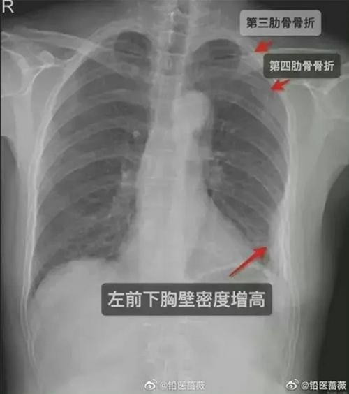 Hậu quả của cái ôm chào hỏi là 3 xương sườn bị gãy. Ảnh: Sina.