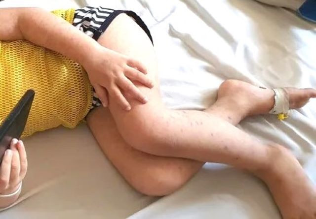 Bệnh nhân mắc tay chân miệng đang điều trị tại Bệnh viện Đa khoa tỉnh Bình Dương Bệnh nhân mắc tay chân miệng đang điều trị tại Bệnh viện Đa khoa tỉnh Bình Dương