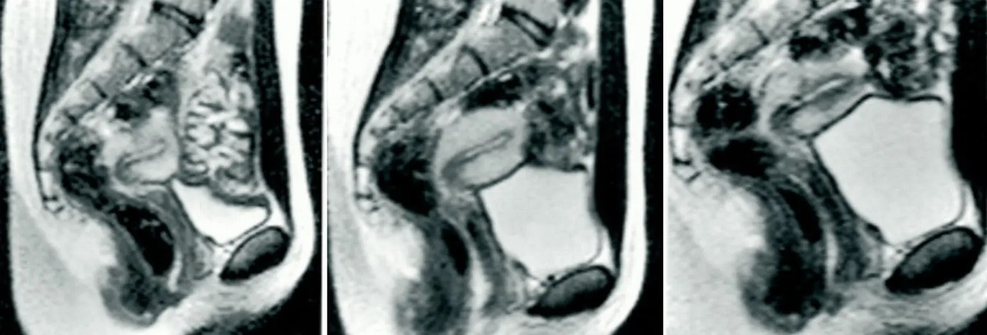 Quá trình quét cho thấy "cậu nhỏ” có hình dạng của một chiếc boomerang khi làm “chuyện ấy” Quá trình quét cho thấy "cậu nhỏ” có hình dạng của một chiếc boomerang khi làm “chuyện ấy”