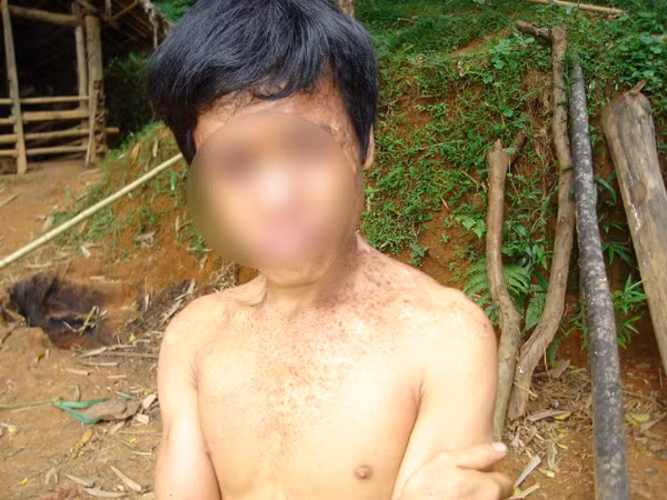 Khuôn mặt của em Xa Văn Hiệp bị biến dạng