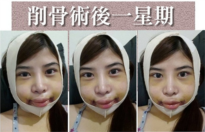 20%- 30% còn lại sẽ giảm từ từ theo thời gian