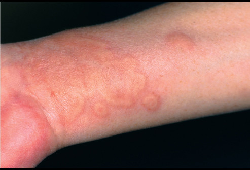 Đề phòng chứng mề đay do giá rét