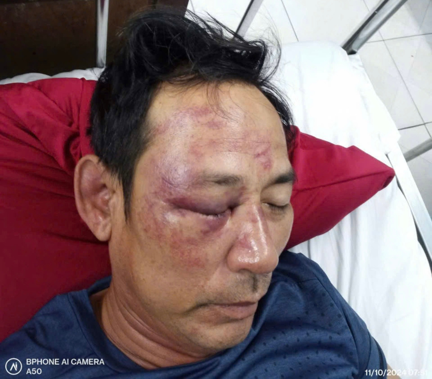 Mặt mũi ông Lư bầm tím và đang được điều trị tại Bệnh viện Trung ương Huế. Ảnh anh Luýt cung cấp. Mặt mũi ông Lư bầm tím và đang được điều trị tại Bệnh viện Trung ương Huế. Ảnh anh Luýt cung cấp.