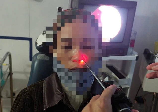 Các y bác sỹ dùng phương pháp nội soi gắp con vắt ra khỏi mũi người phụ nữ. Các y bác sỹ dùng phương pháp nội soi gắp con vắt ra khỏi mũi người phụ nữ.