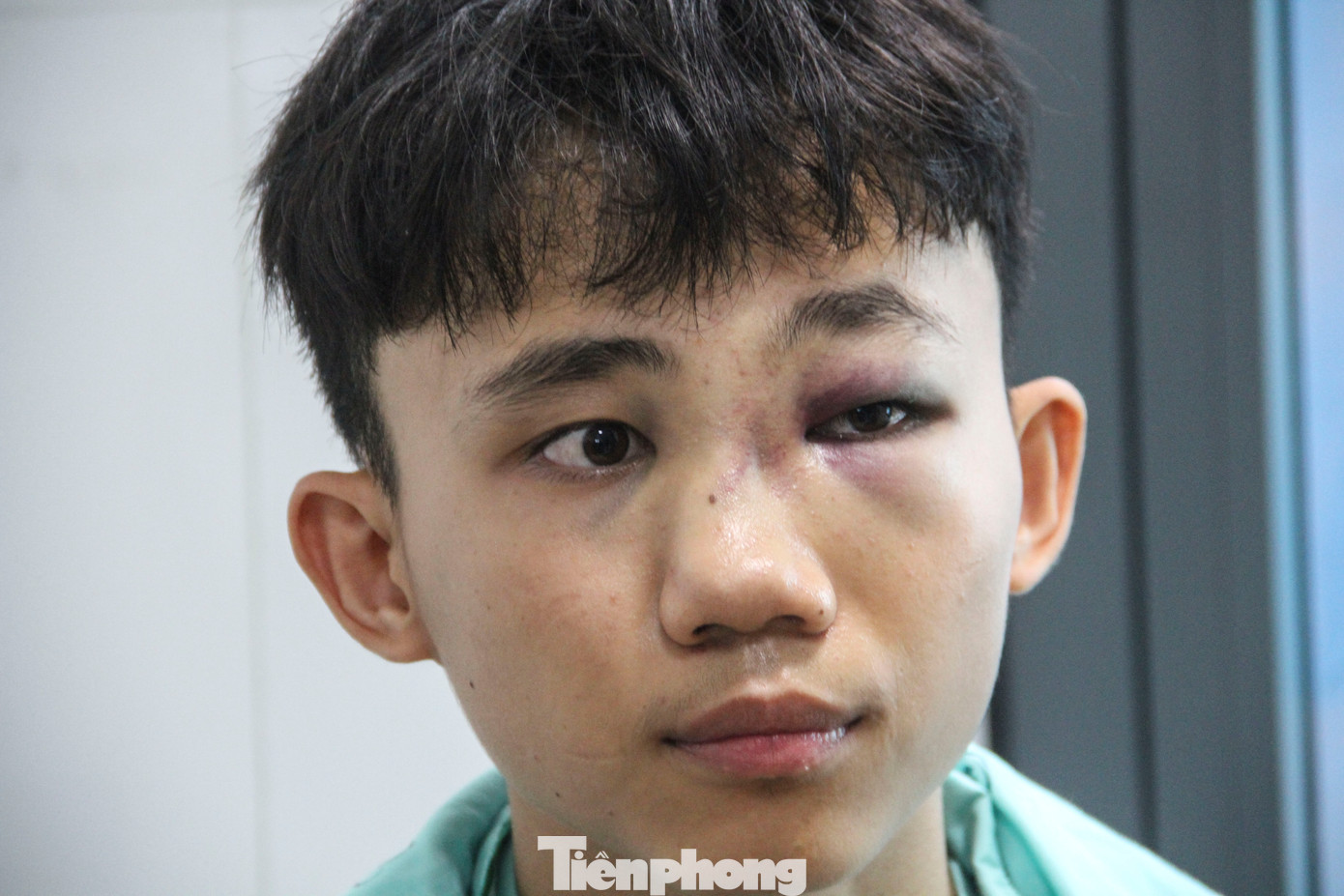 Em Thương bị đánh gãy xương chính mũi, (Ảnh: Trương Định) Em Thương bị đánh gãy xương chính mũi, (Ảnh: Trương Định)