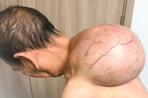 Khối u trên vùng lưng của bà R. Ảnh: Bệnh viện Bình Định