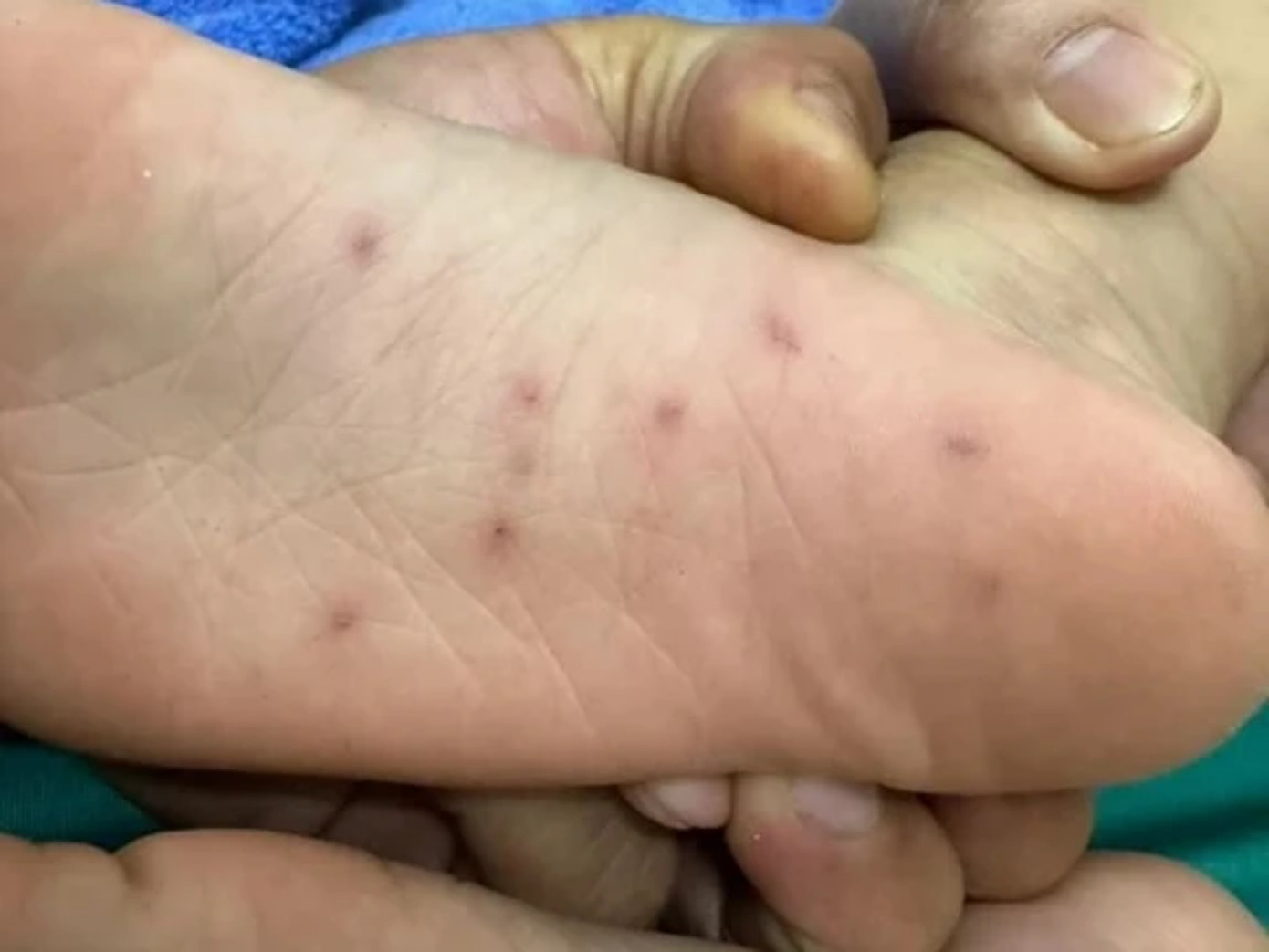Hình ảnh lòng bàn chân của cháu H. được chia sẻ trên mạng xã hội. Ảnh chụp màn hình Hình ảnh lòng bàn chân của cháu H. được chia sẻ trên mạng xã hội. Ảnh chụp màn hình