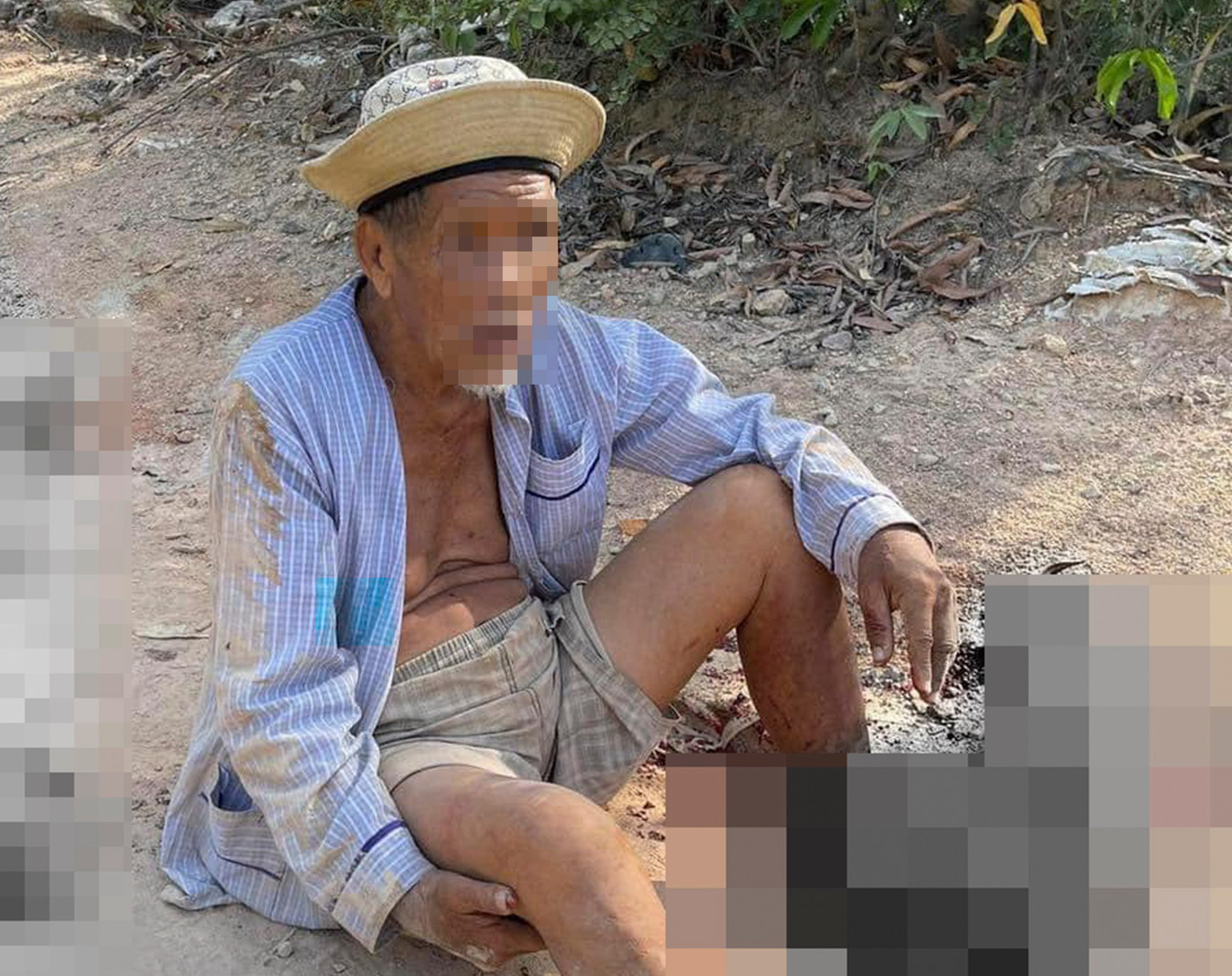 Cụ ông bị chiếc xe tông khiến hai bàn chân bị dập nát. Ảnh: SOS 115 - tỉnh Bình Định Cụ ông bị chiếc xe tông khiến hai bàn chân bị dập nát. Ảnh: SOS 115 - tỉnh Bình Định