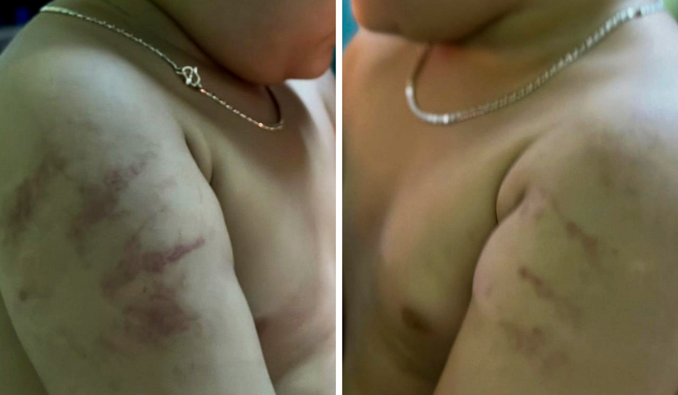 Vết bầm trên 2 cánh tay cháu bé. (Hình ảnh được chia sẻ)