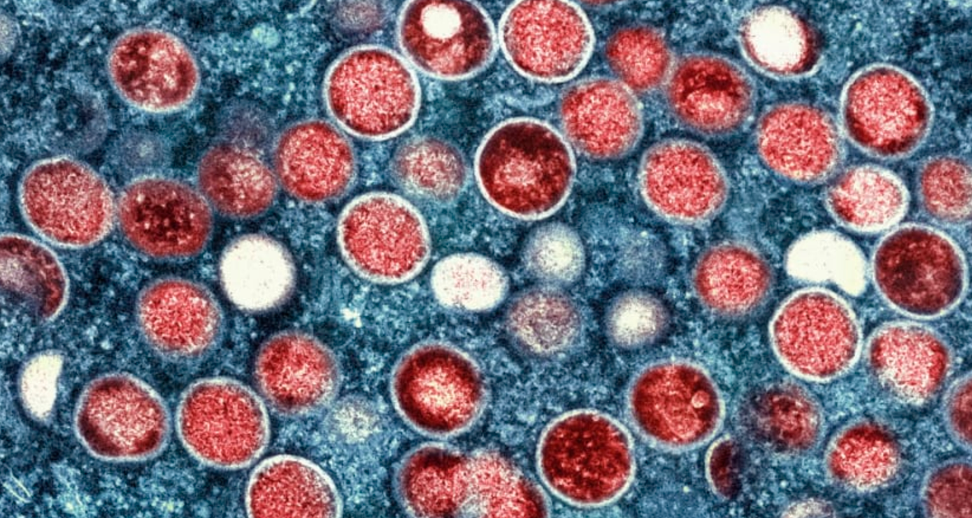 Một chủng mới của bệnh đậu mùa khỉ đang lây lan nhanh ở châu Phi. Một chủng mới của bệnh đậu mùa khỉ đang lây lan nhanh ở châu Phi.