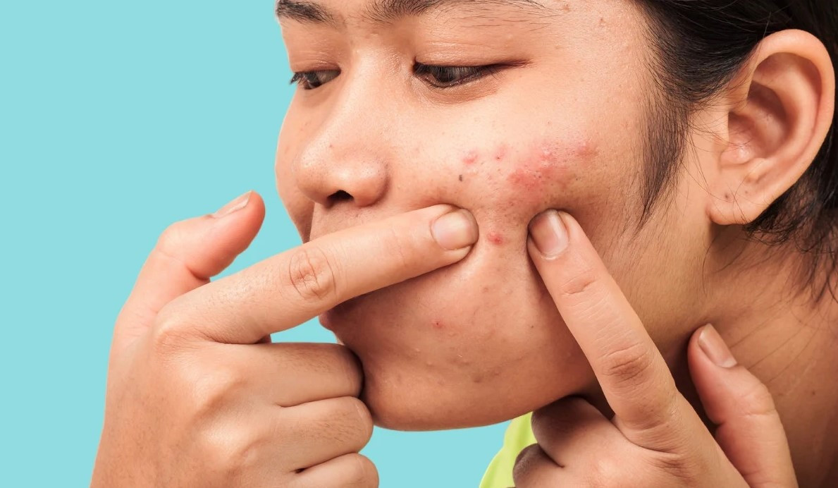 Nặn mụn không đúng cách sẽ gây viêm, kích ứng da và làm vi khuẩn trong nhân mụn lây lan sang các vùng da khác. Nặn mụn không đúng cách sẽ gây viêm, kích ứng da và làm vi khuẩn trong nhân mụn lây lan sang các vùng da khác.