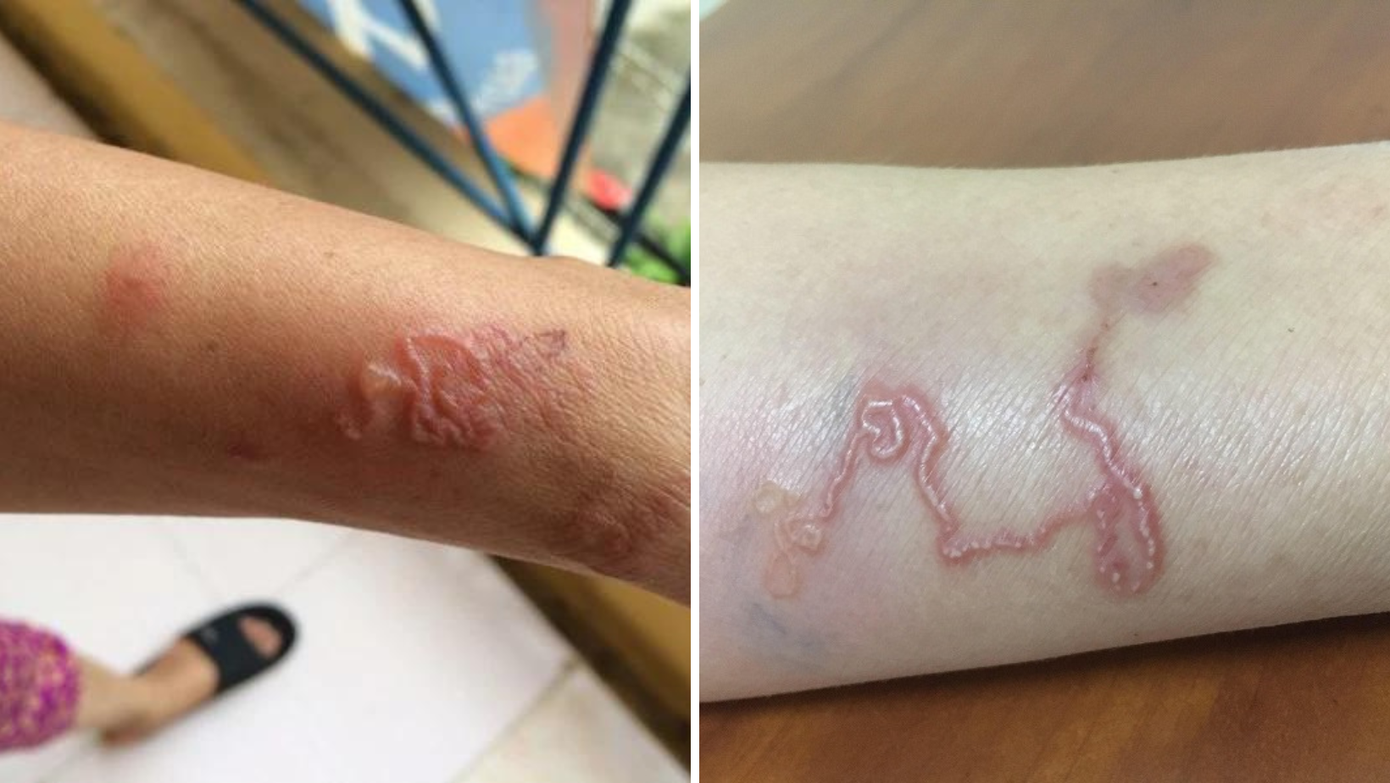 Một bệnh nhân bị nhiễm giun đũa từ chó mèo trong nhà.