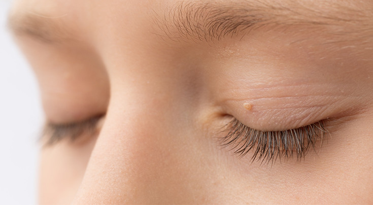 Có thể bị ung thư da tại mắt, xuất hiện dưới dạng các nốt nhỏ, trông như tàn nhang, ở bên trong mắt.