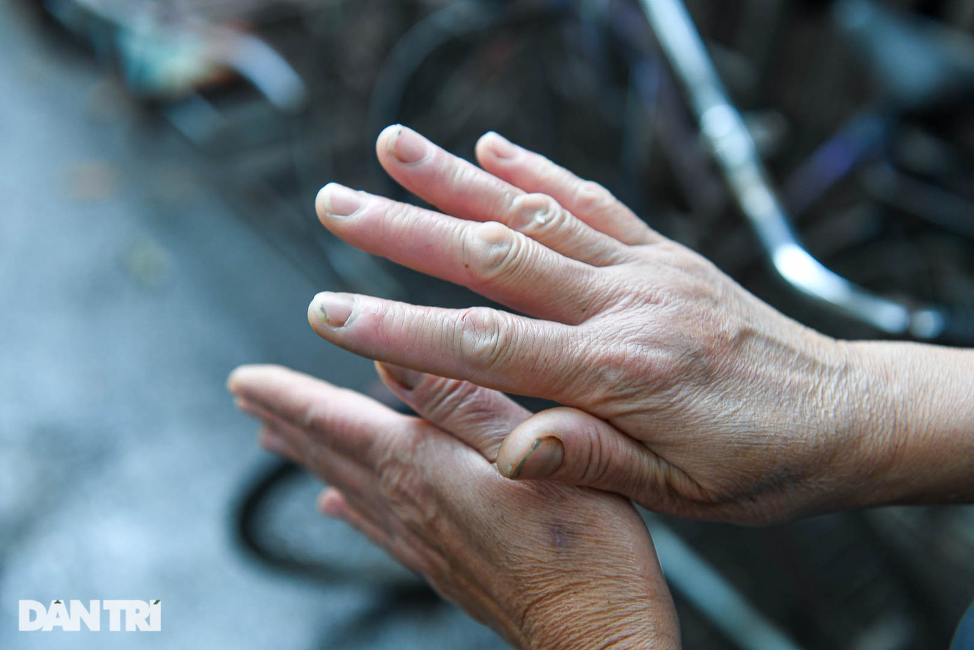Bà Hòa bị cước tay do thường xuyên tiếp xúc với đá lạnh vào mùa đông (Ảnh: Toàn Vũ)
